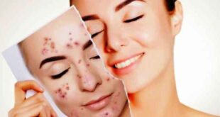 Cara Menghilangkan Bekas Jerawat dengan Alami dan Mudah