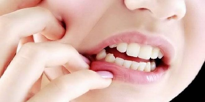 Penyebab Gigi Ngilu Tiba Tiba dan Berkepanjangan, Solusi, dan Tips Merawat Gigi Sensitif